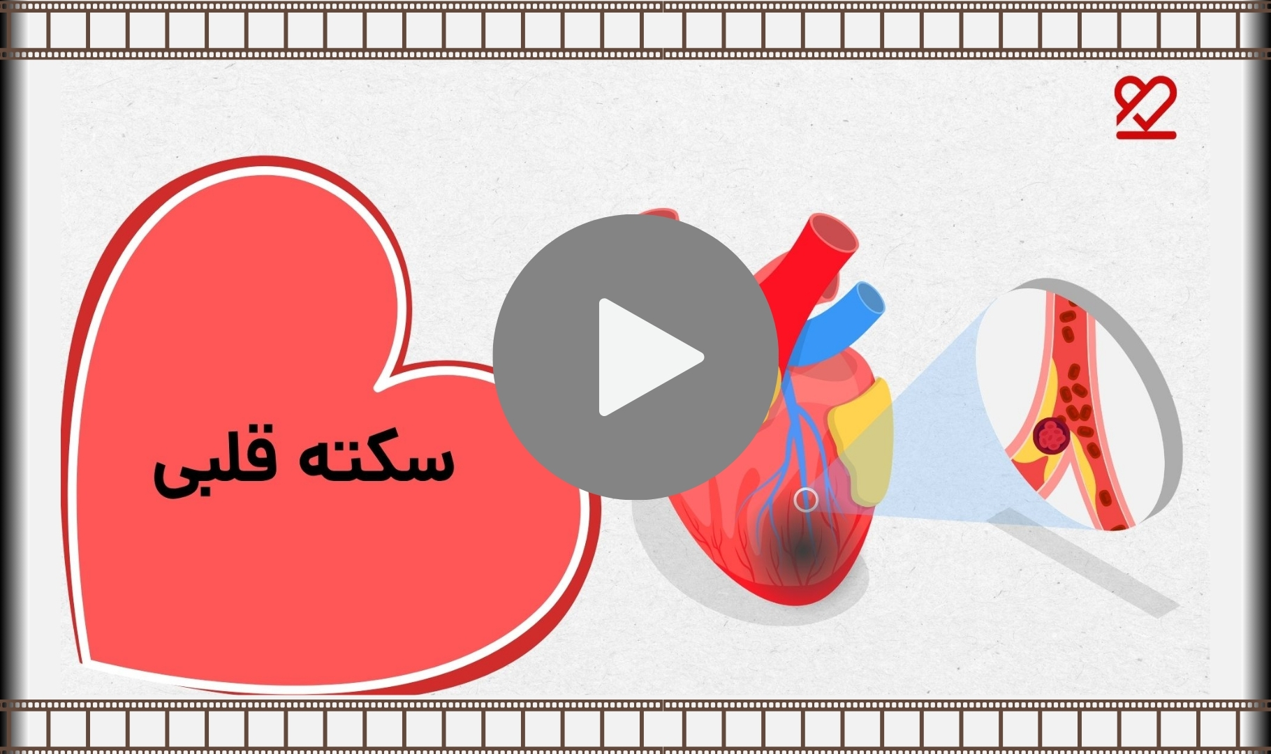 سکته قلبی
